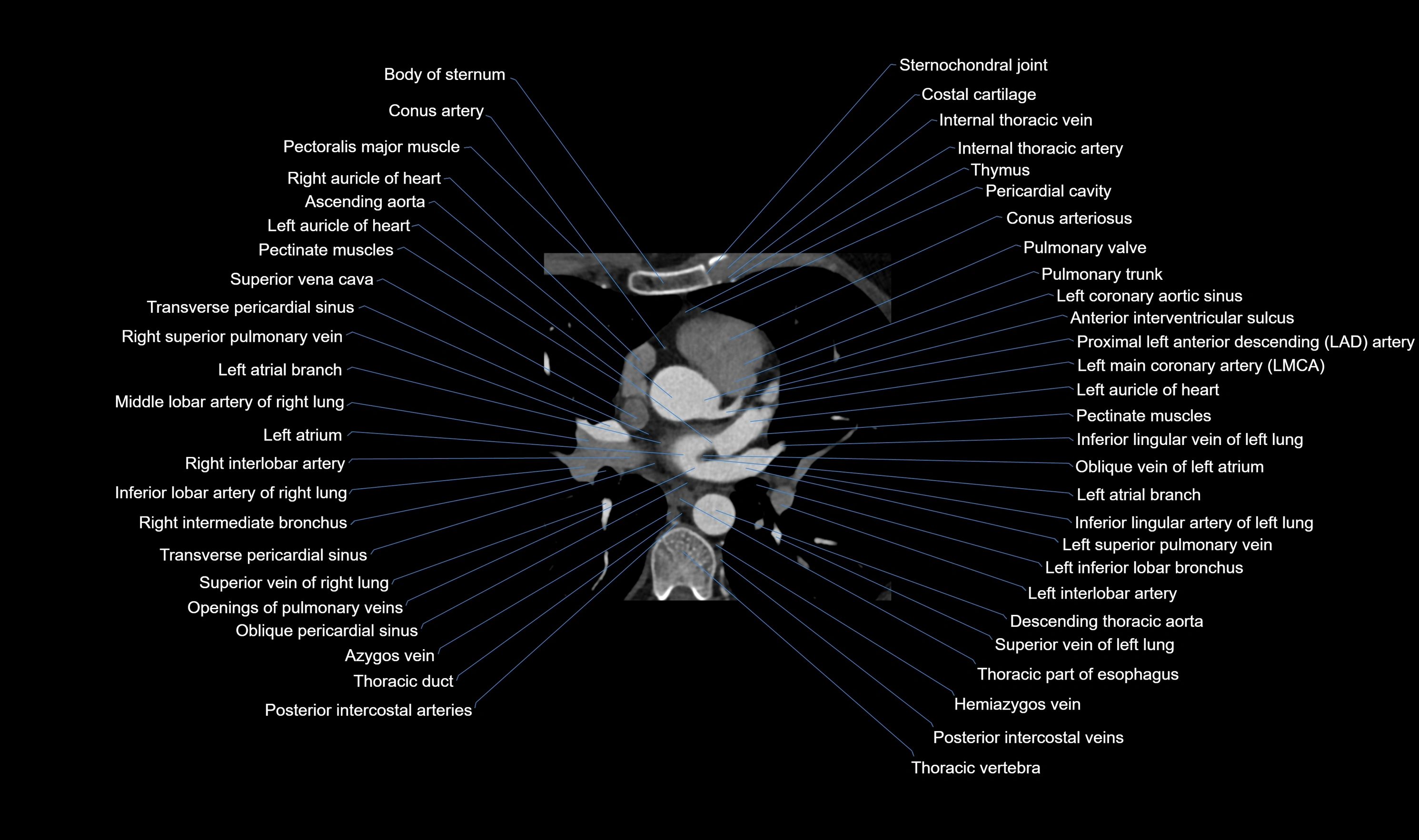 CT heart (coronary angiogram) axial view cross sectional anatomy labelled radiology image-00021.webp